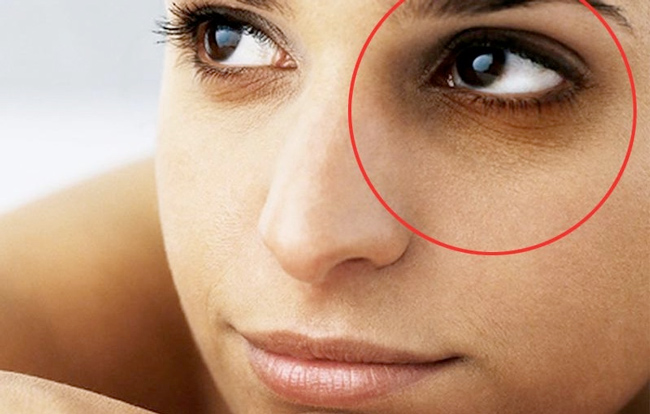 how to get rid of dark circles under your eyes